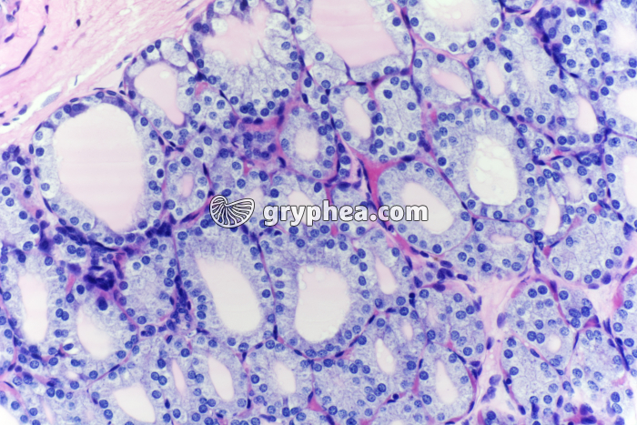 Thyroïde en hyperactivité x100 - gryphea.com